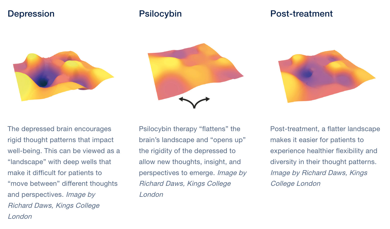 Depressed brain visualizations before, during and after psilocybin treatment