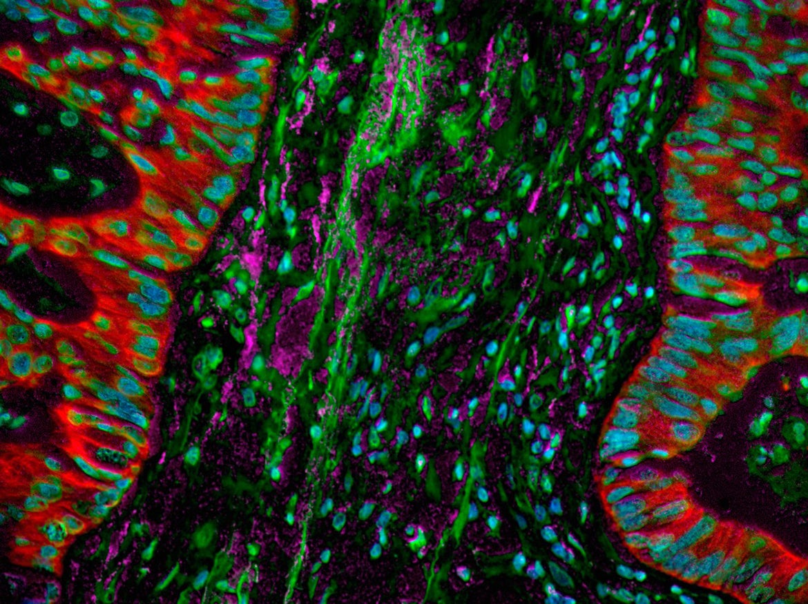 Lung cancer cells